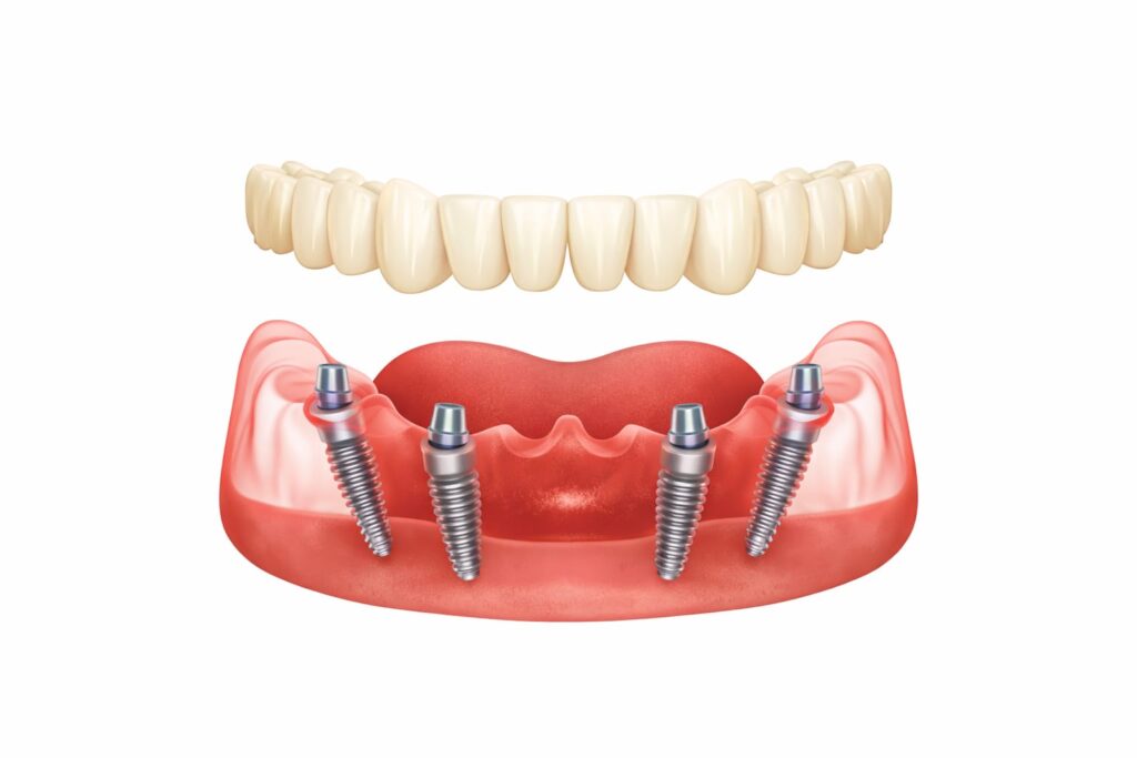 All-on-4 in Albania illustration showing a full-arch bridge supported by four implant
