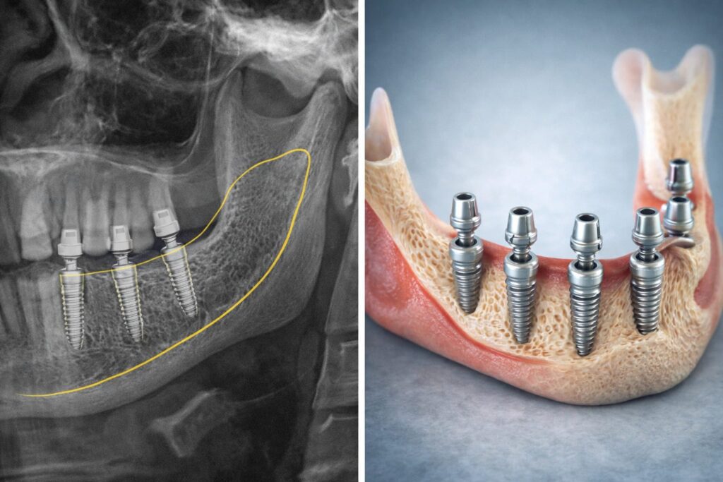 Jawbone scan and implant anatomy illustration showing bone support and implant positioning in full-arch treatment