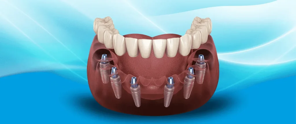All-on-6 implant illustration showing a full-arch bridge supported by six implants