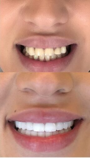Before-and-after crown smile makeover showing a refined and natural-looking result