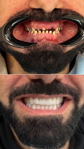 Before-and-after restored smile case showing clear improvement in the smile