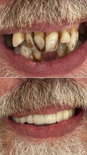 Before-and-after smile rehabilitation case showing improved tooth shape and finish