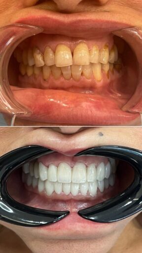 Before-and-after zirconia crown case showing a brighter and more even smile