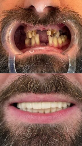 Before-and-after implant restoration showing missing teeth replaced with a restored smile