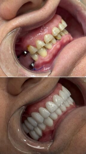 Hybrid restoration case showing a full-arch restored smile from a side view
