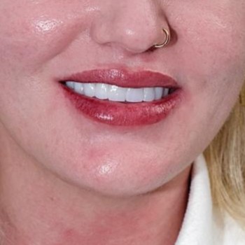 Close-up of smile improvement case with a clean and natural-looking finish