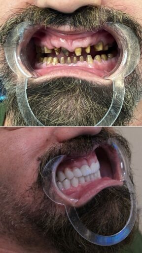 Before-and-after full mouth restoration showing restored upper and lower teeth