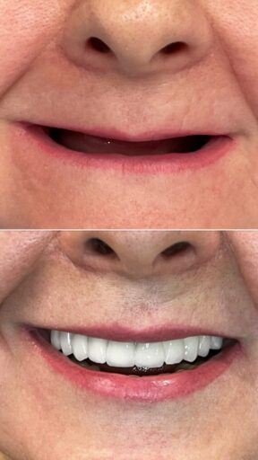 All-on-6 implant restoration showing a full-arch smile result