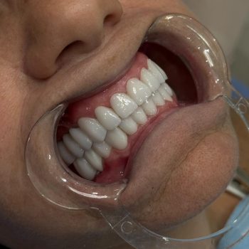 Close-up of full smile restoration showing a bright, even, balanced result