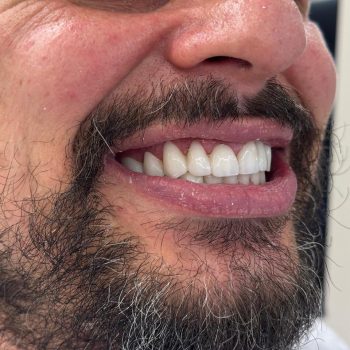Side-view smile rehabilitation case showing natural aesthetics and a strong finish